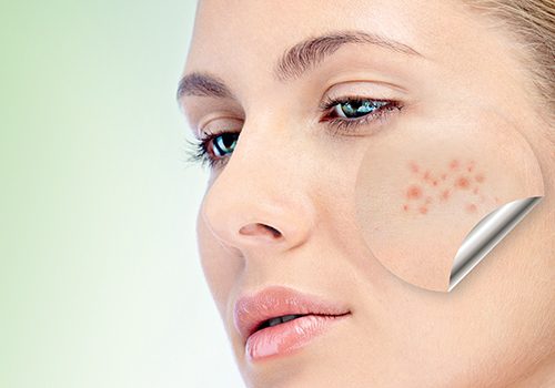 Acne-Prone Skin Care